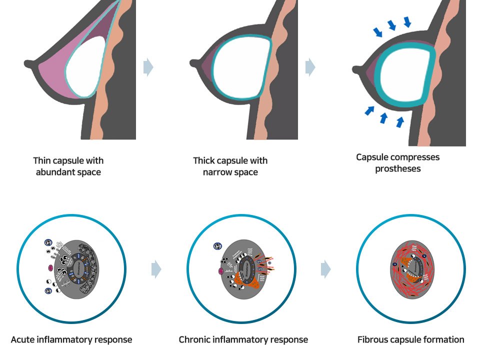 capsular contracture